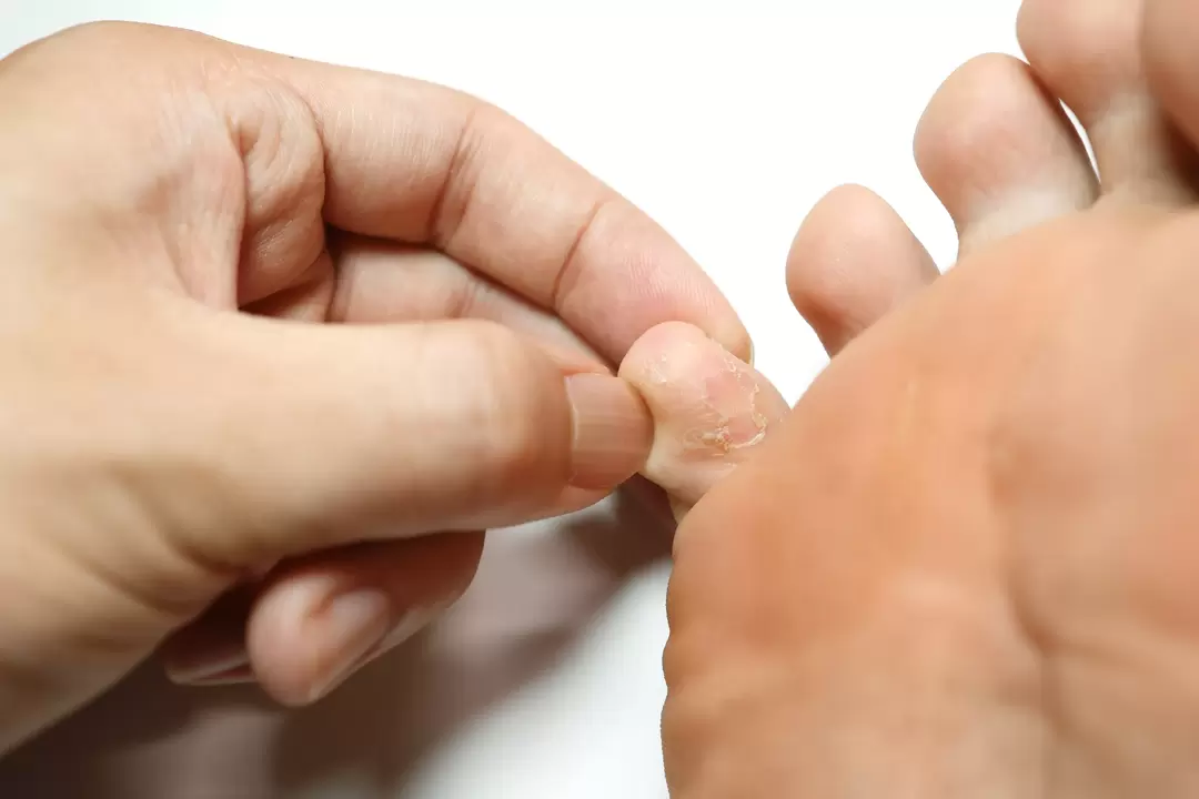 Schimmel op de vingers en de behandeling ervan met zxcvbnmqwert crème met crème