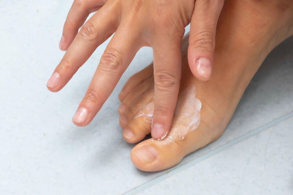 Toepassing van Demyxil -crème van de schimmel tussen de tenen