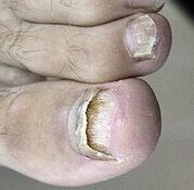 Gelanceerde nagelschimmel