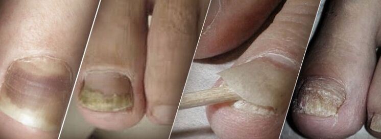 Onychomycosis