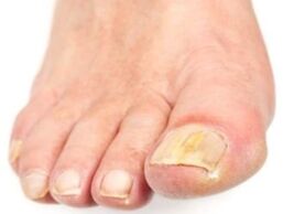 Nagelschimmel
