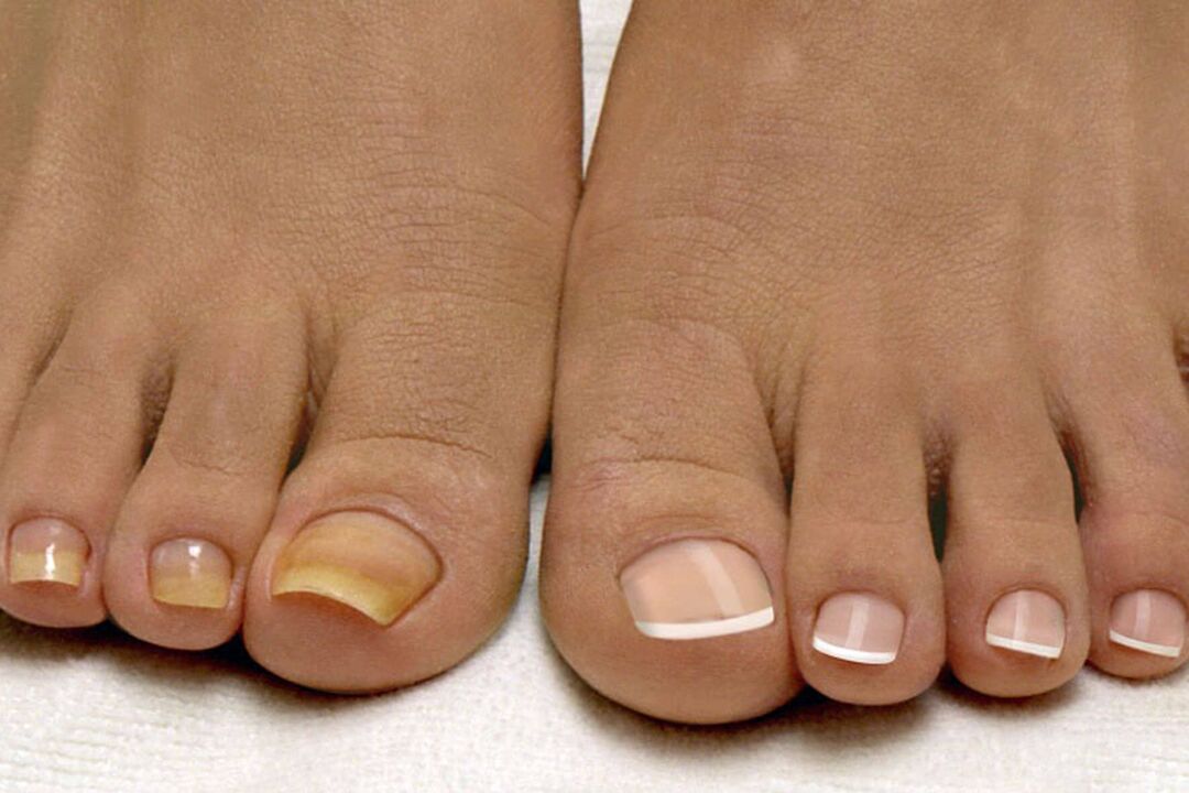 Op de ene been gezonde nagels, aan de andere kant met een schimmel