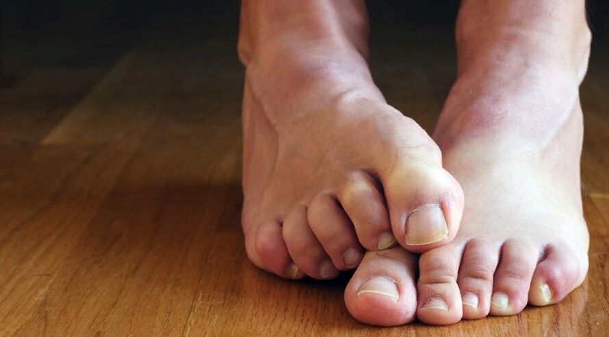 Symptomen van nagelschimmel