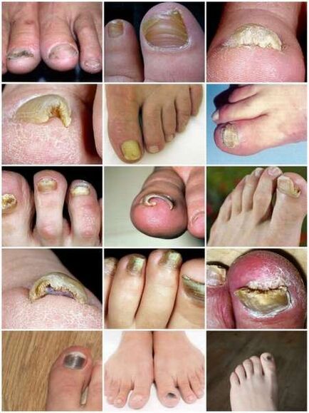 Schimmelinfectie van de teennagelplaat