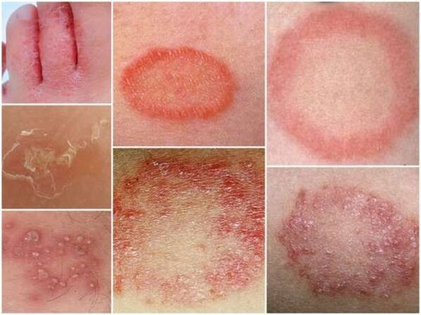 Trichophytosis van de huid van de benen